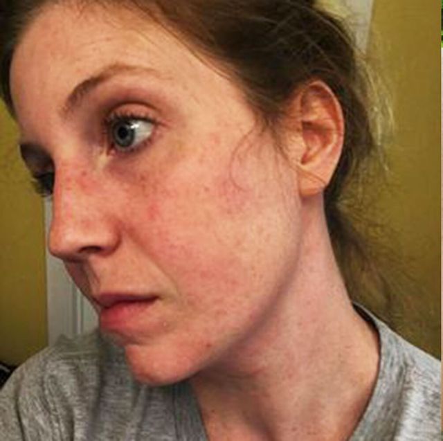 Top 10 Rarest Allergies