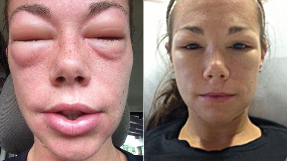 Top 10 rarest allergies
